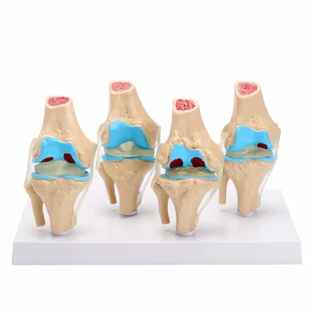 Един комплект Анатомични модели на колянна става на 4 етапа на остеоартроза на гръбначния, комплект от 4